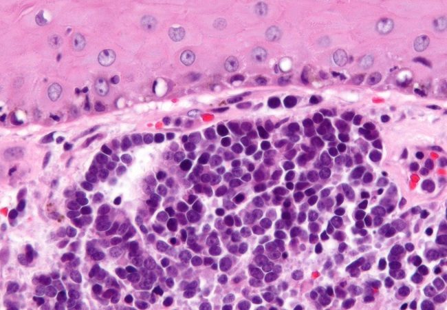 Merkel cell carcinoma pathology 
