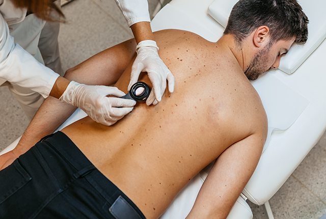 Skin cancer screening on man's back