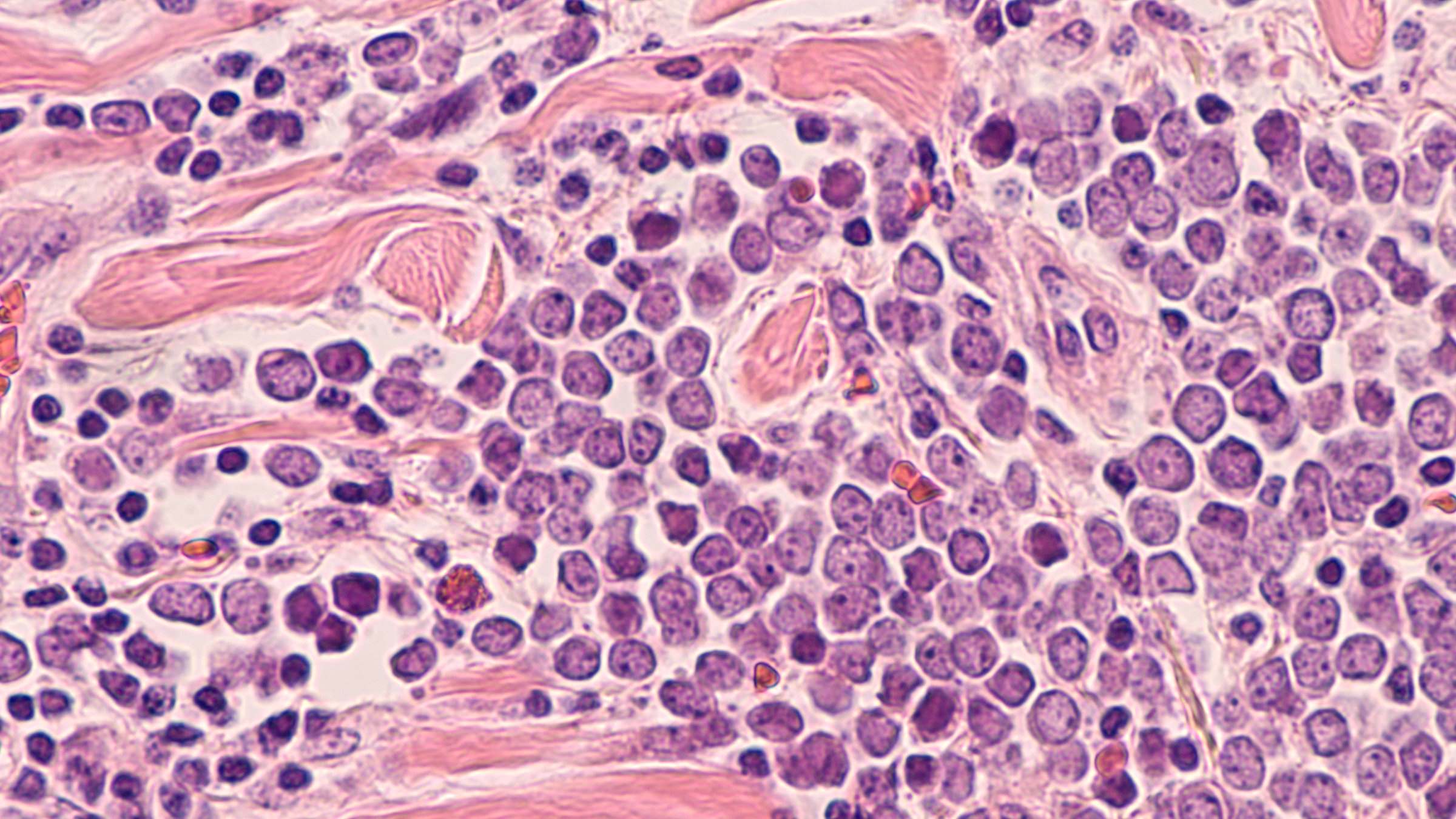 Merkel cell pathology 