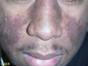 Patient with skin condition 