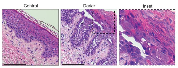 Darier disease pathology