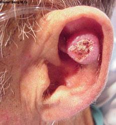 Squamous Cell Carcinoma of ear.