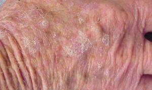 Numerous actinic keratoses on the hand.