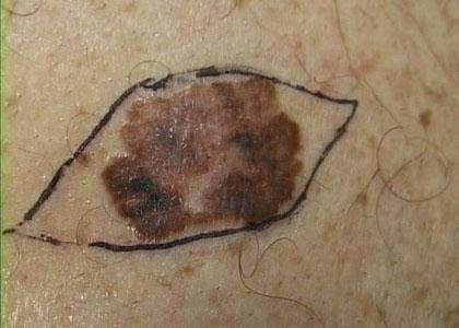 Melanoma (outlined for biopsy removal).