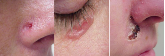 Basal cell on nose, cheek and lip (near the nose).